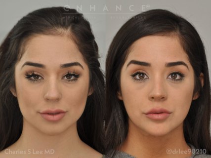 Rhinoplasty