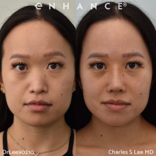 Rhinoplasty
