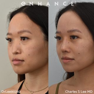 Rhinoplasty
