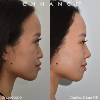 Rhinoplasty