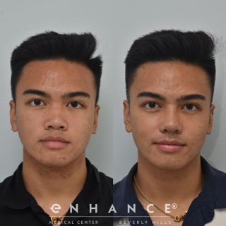 Rhinoplasty