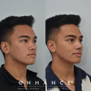 Rhinoplasty