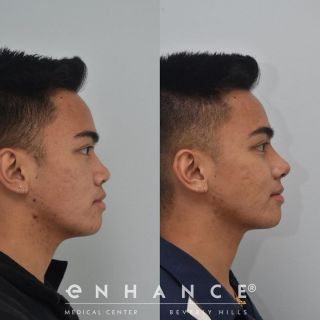 Rhinoplasty
