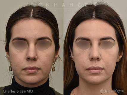 Rhinoplasty