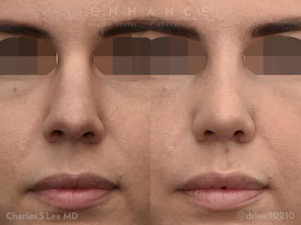 Rhinoplasty