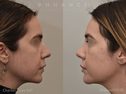 Rhinoplasty