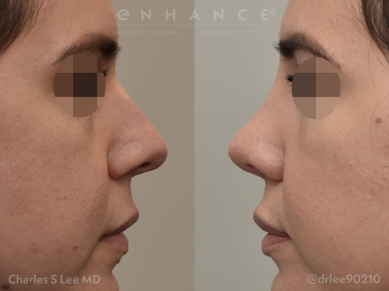 Rhinoplasty