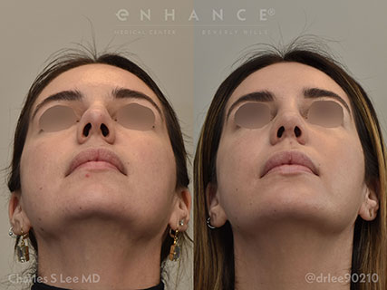 Rhinoplasty
