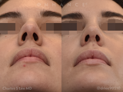 Rhinoplasty