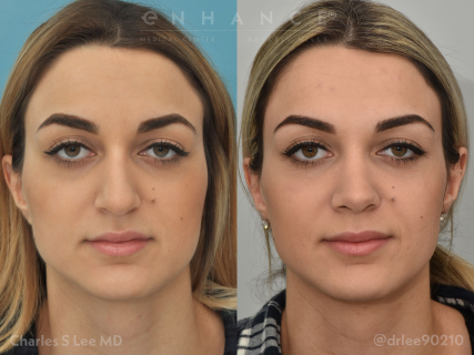 Rhinoplasty