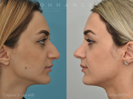 Rhinoplasty