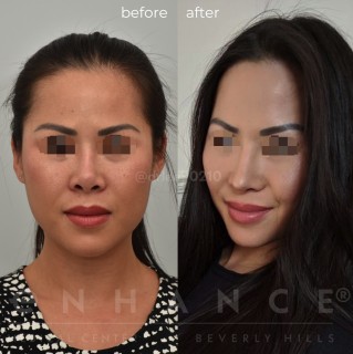 Rhinoplasty