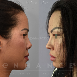 Rhinoplasty
