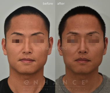 Rhinoplasty