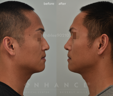 Rhinoplasty
