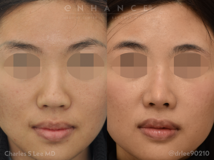Rhinoplasty