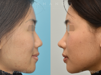 Rhinoplasty