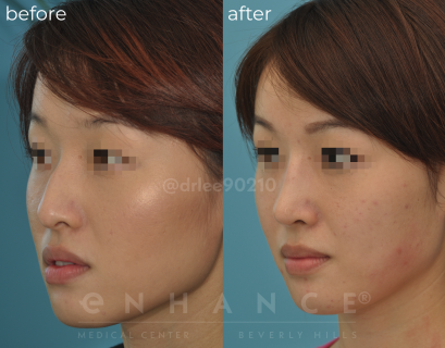 Rhinoplasty
