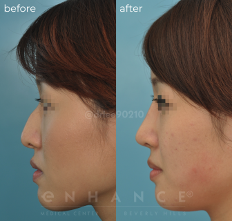 Rhinoplasty