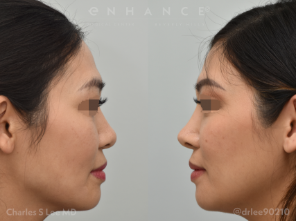 Rhinoplasty