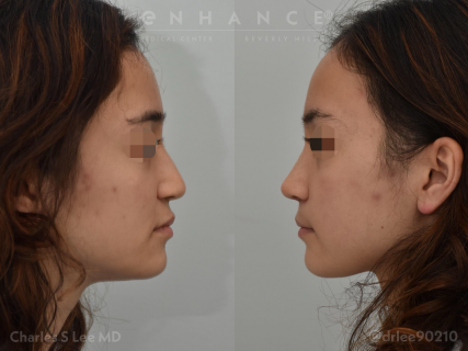 Rhinoplasty