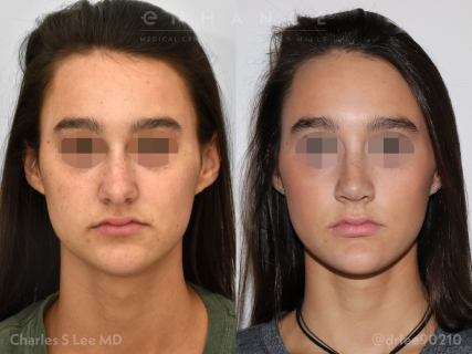 Rhinoplasty