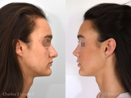 Rhinoplasty