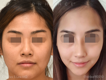 Rhinoplasty