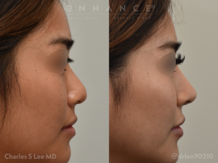 Rhinoplasty
