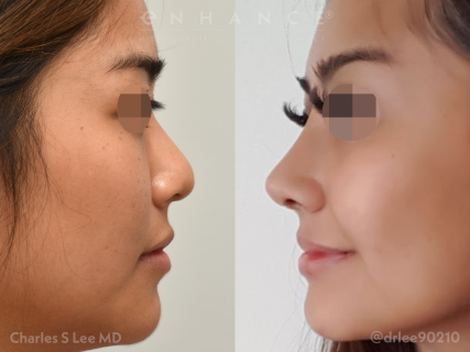 Rhinoplasty