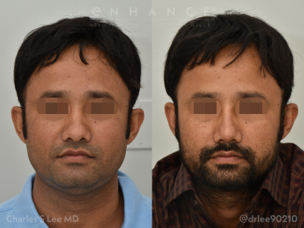 Rhinoplasty