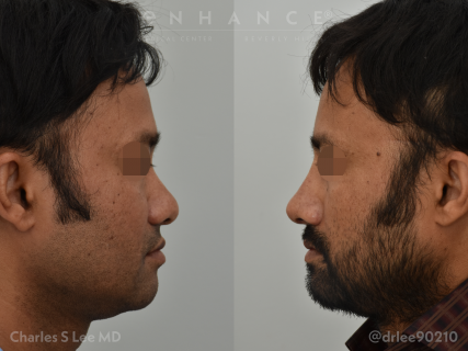 Rhinoplasty