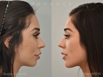 Rhinoplasty