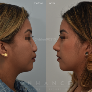 Rhinoplasty