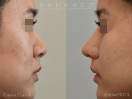 Rhinoplasty