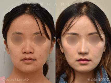 Rhinoplasty