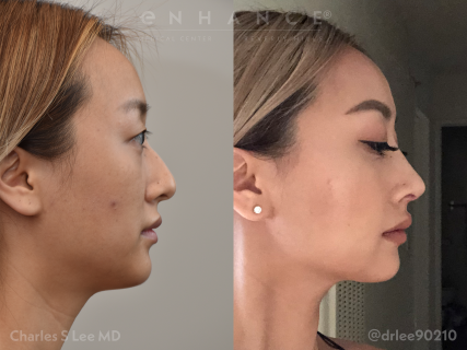 Rhinoplasty