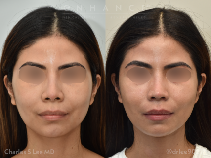 Rhinoplasty