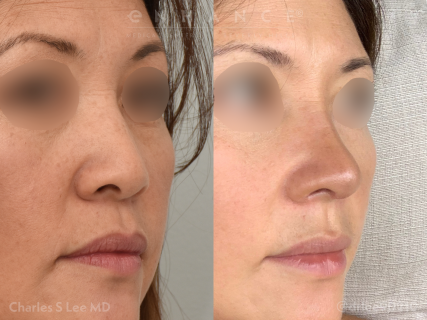 Rhinoplasty