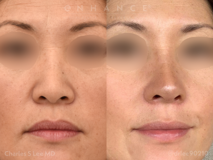 Rhinoplasty