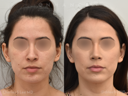 Rhinoplasty