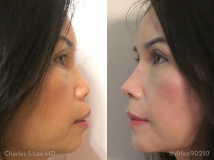 Rhinoplasty and Lower Eyelid Surgery