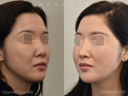 Rhinoplasty
