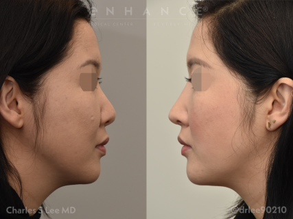 Rhinoplasty