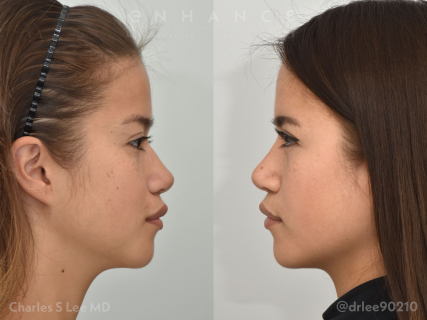 Rhinoplasty and Eyelid Surgery