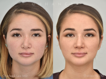 Rhinoplasty and Septoplasty
