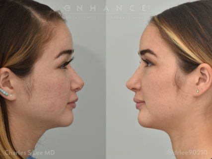 Rhinoplasty and Septoplasty