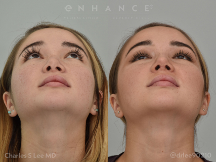 Rhinoplasty and Septoplasty