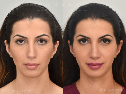 Rhinoplasty