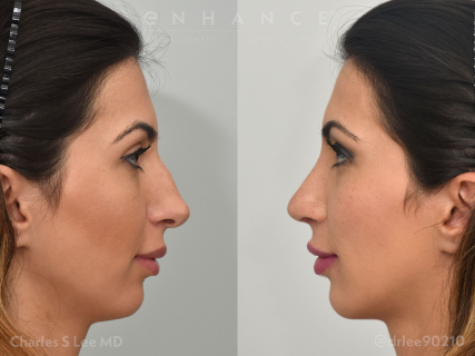 Rhinoplasty